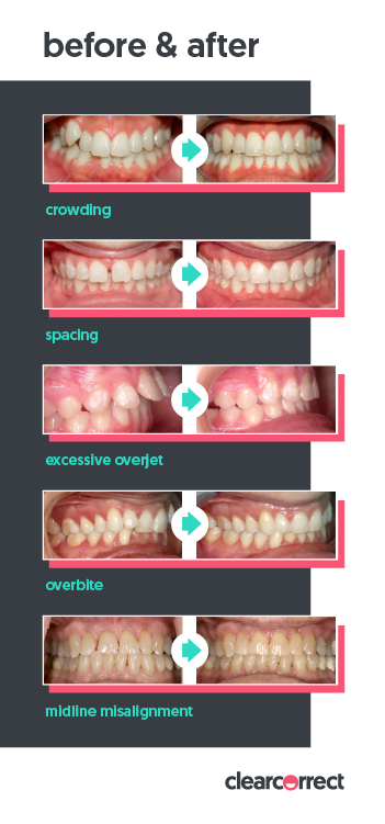 Clear Metal Braces in Rhode Island